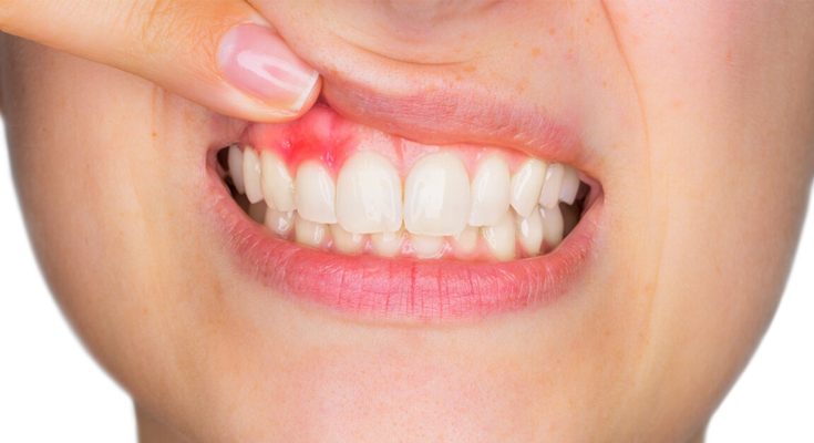 natural remedies for bleeding gums