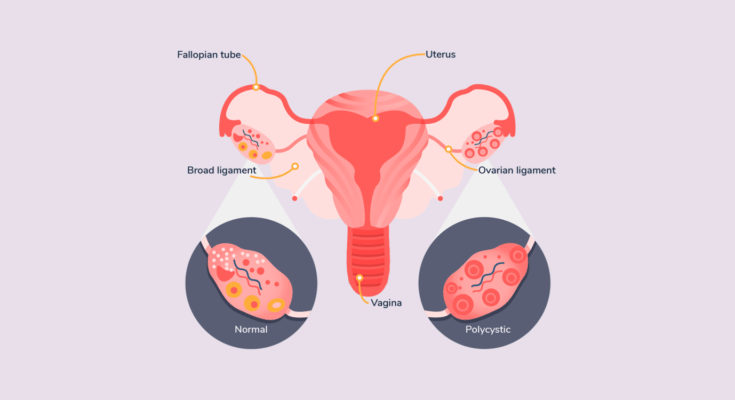 PCOS medical treatment